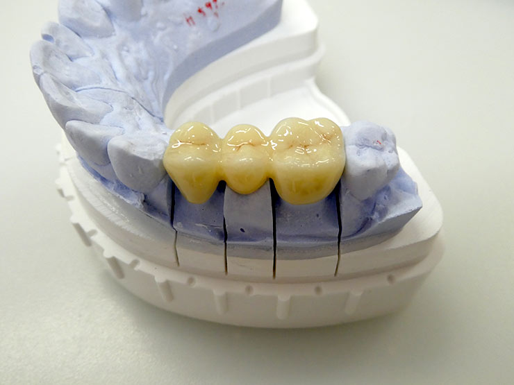 装着前の技工物