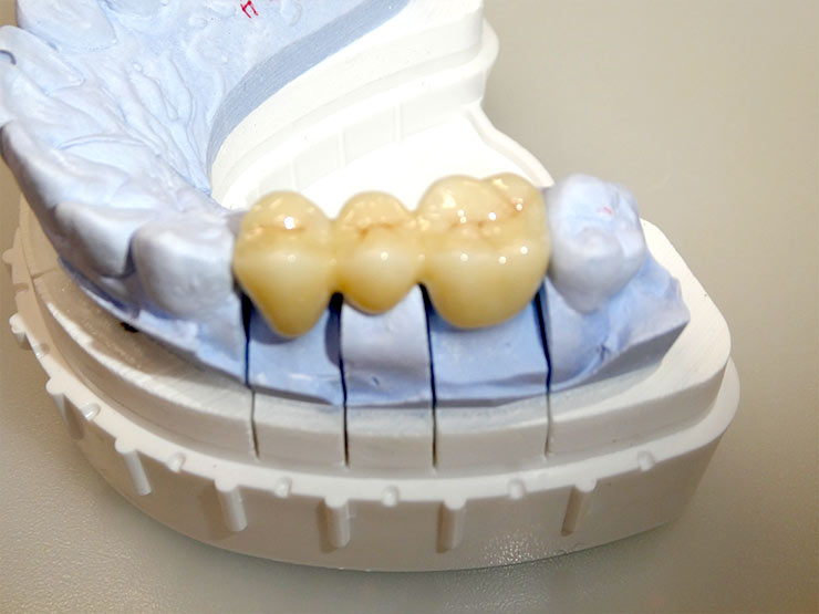 装着前の技工物