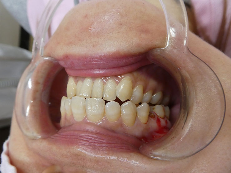 入間市での入れ歯症例：自費審美ジルコニアセラミック装着前（Before）
