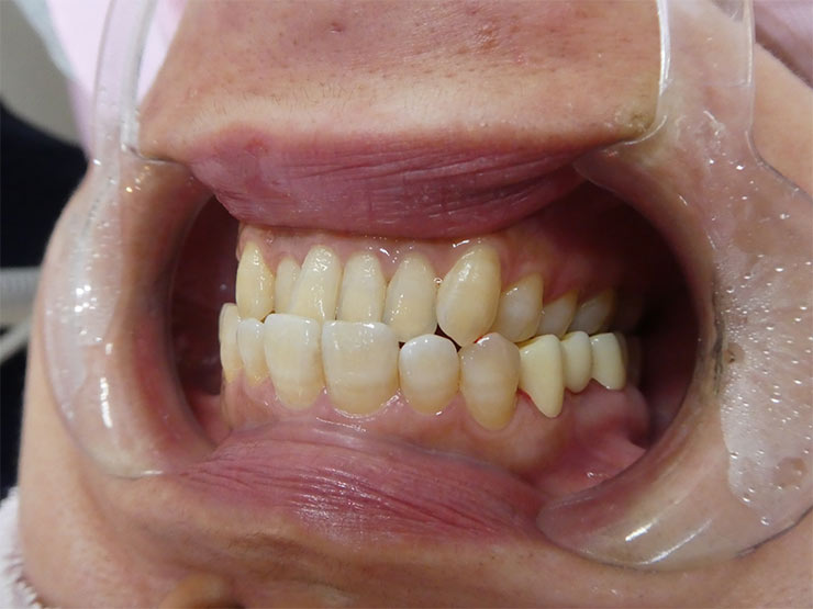 自費審美ジルコニアセラミック装着後（After）