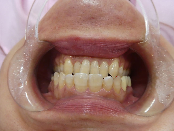 自費審美ジルコニアセラミック装着後（After）