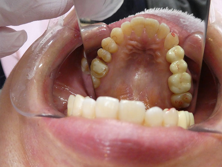 自費審美ジルコニアセラミック装着後（After）