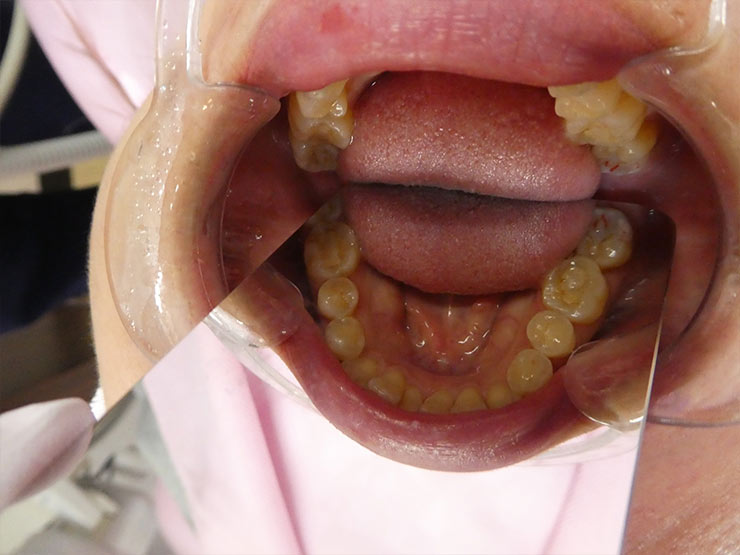 自費審美ジルコニアセラミック装着後（After）